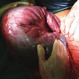Fournier gangrene is a type of gangrene characterized by the necrosis of cells around the penis. Fournier's gangrene of scrotum following orchidectomy for ...