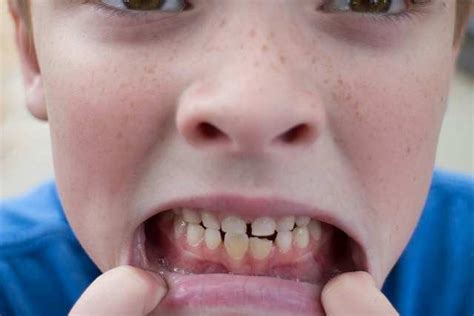 دندان‌ قروچه کودکان علت‌ها و راه‌های درمانی درمانگاه دندانپزشکی حکیم