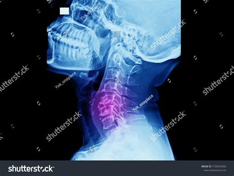 Lateral Projection Xray Cervical Spine Showing Stock Photo 1739553392