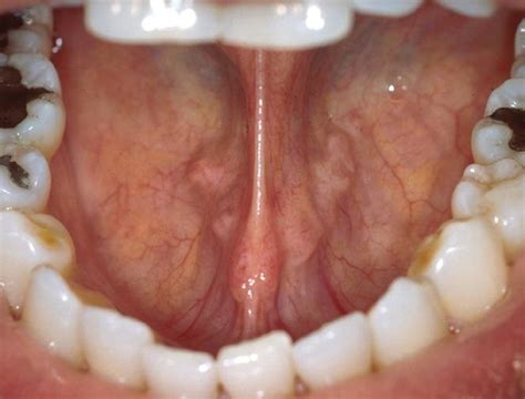 Floor Lesions Mouth Photo