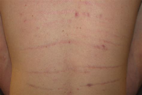 Why The Stripes Advances In Dermatology
