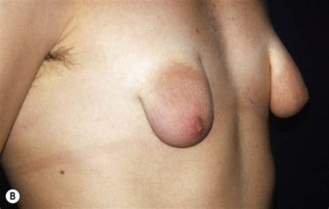 Puffy And Malformed Tits Lovely Areolas Plastic Surgery 113 Pics Xhamster