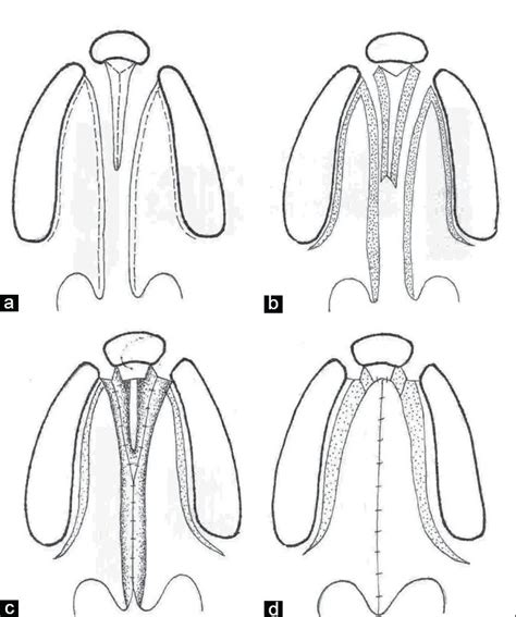 Cleft Palate Repair And Variations Scienceopen