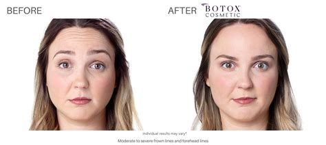 Botox Before And After Real Patient Results In Chatham