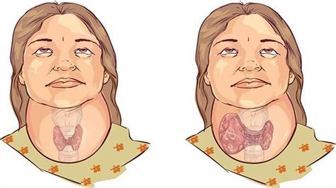 How To Prevent Goiter Tips For Treating Goiter Youtube