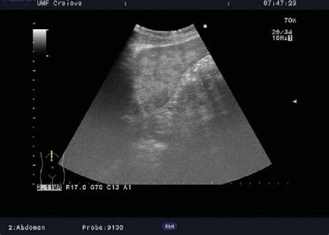 Abdominal Ultrasound Multiple Hepatic Metastasis In Left Lobe