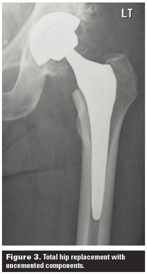 Total Hip Replacement Relieving Pain And Restoring Function British