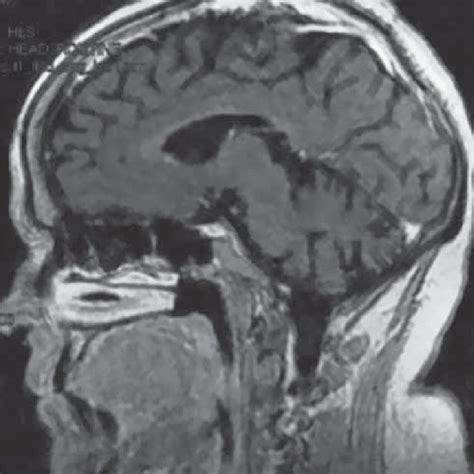 Coma Onset Eeg Portion Of The Eeg Recording Showing Diffuse Sharp