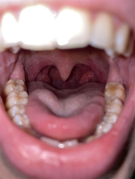 Swollen Lymph Nodes In Neck Enlarged Tonsil On Same Side Raskdocs