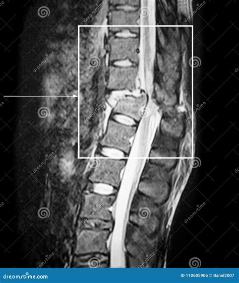 Fracture Spin Cord Interruption Compression Ct Scan Stock Photo