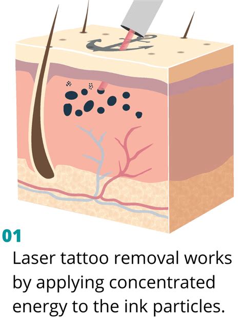 How Laser Tattoo Removal Works Removery