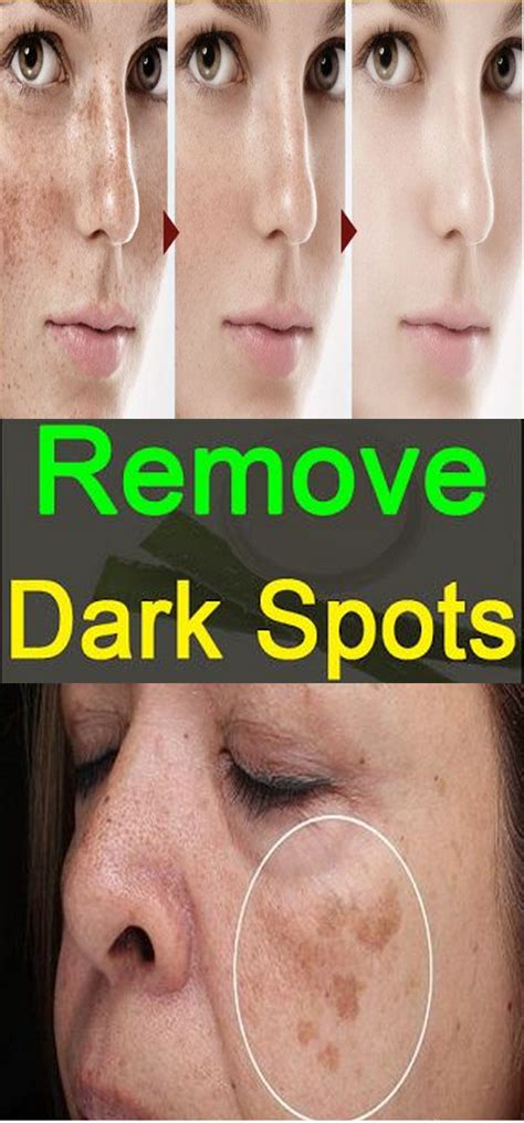 Remove Dark Spots On Your Face In Just 3 Nights In 2022 Remove Dark