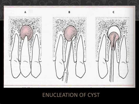Management Of Oral Cyst