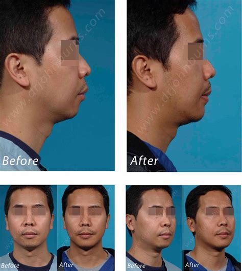 Chin Shapinggenioplasty Before And After Photo Gallery Dr John Burns