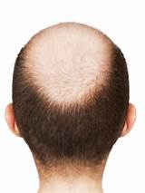 Pictures of Alopecia Doctor
