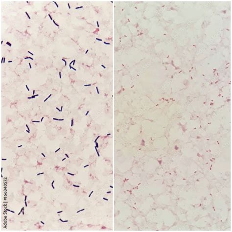 Two Smear Patterns Of Human Blood Cultured Grams Stained With Gram