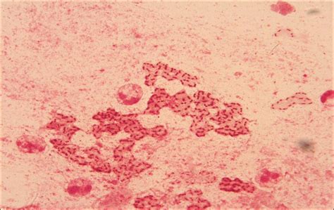 Gram Stain For Sputum Smear From Cystic Fibrosis Patient