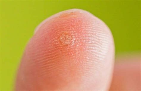 There are also occasions when seed warts show up with each other with plantar warts, but this transpires rarely. 45 Effectual Home Remedies to Get Rid of Warts