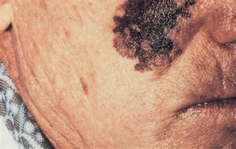 What Is Melanoma Get The Facts