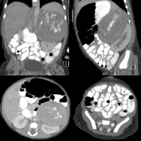 Newborn with a left abdominal mass and palpable subcutaneous nodules on