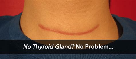 How To Fix Your Thyroid Health Without Your Thyroid Rai And