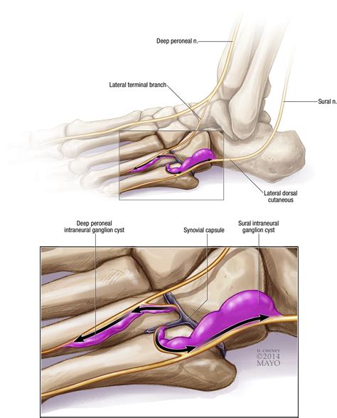 Concurrent Lateral Dorsal Cutaneous And Deep Peroneal Intraneural