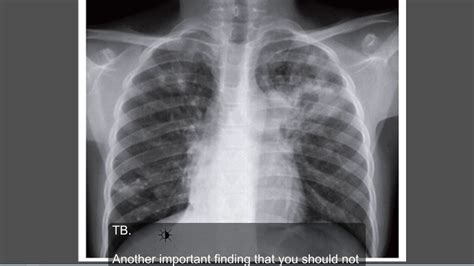 Chest X Ray Tb Vs Normal