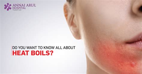 Do You Want To Know All About Heat Boils Multispeciality Hospitals
