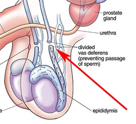 Sperm Granuloma Vasectomy