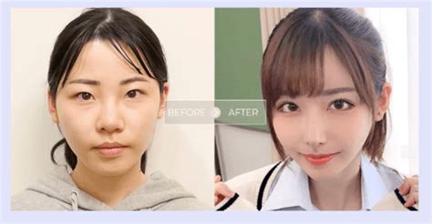 Eimi Fukada Surgery Photo【id Cosmetic Surgery】 Surprise Impact Before