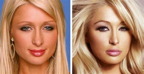 American Celebrity Paris Hiltons Before And After Plastic Surgery