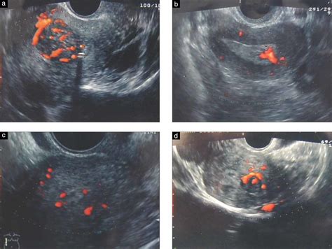 Uterine Polyps Ultrasound