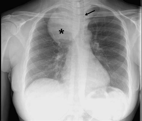 Cureus A Case Report Of Pulmonary Embolism Caused By Substernal Goiter
