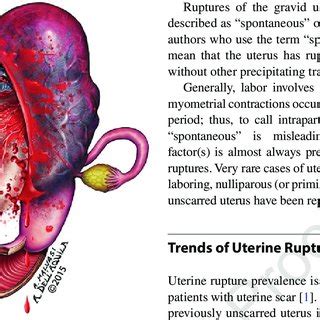 A Description Of A Complete Uterine Rupture With The Sudden Download Scientific Diagram
