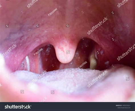 Tonsillitis Pus On Tonsils Throat Infection Stock Photo 1455233321