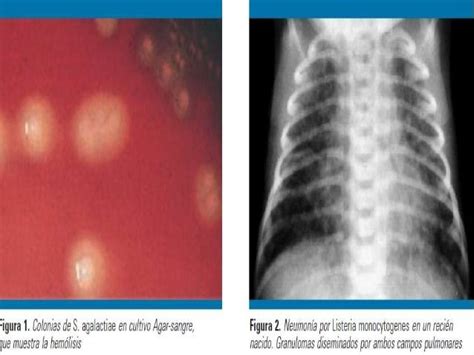 Neumonia Neonatal Neonatologia Enfermedades Respiratorias Del Rn