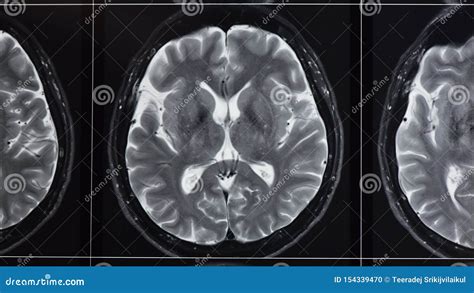 Photograph Of T Weighted Magnetic Resonance Imaging Of Normal Brain