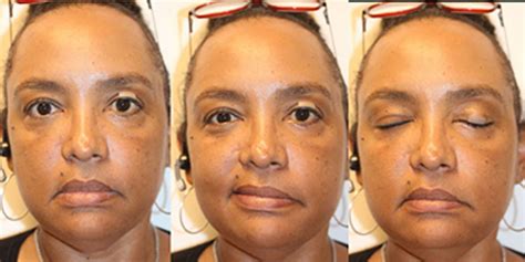 Key Pearls For Managing A Facial Nerve Palsy Patient American Academy