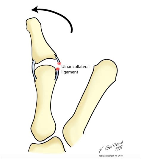 Ulnar Collateral Ligament Ucl Injury Of Thumb Fife Virtual Hand Clinic