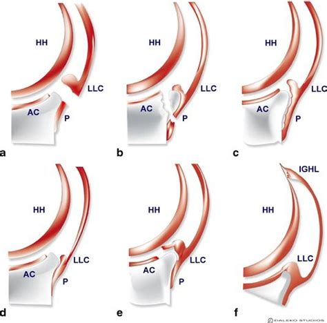 Lesion De Bankart Resonancia Magnetica