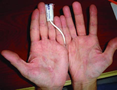Non Pruritic Maculopapular Palmar Rash In A Patient With Syphilitic