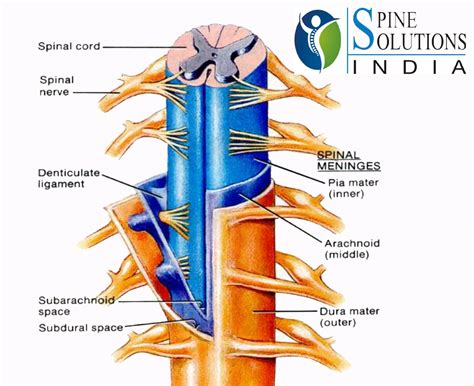 Spine Solutions India By Dr Sudeep Jain Arachnoiditis A Chronic Pain And Neurologic Problems