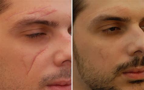 Scar Revision Before And After Nyc Scar Reduction Results