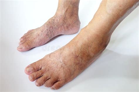 Varicose Veins In The Feet And Legs Stock Photo Image