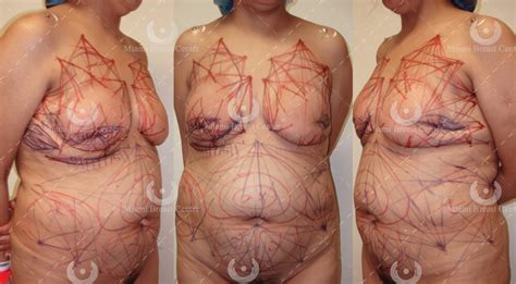 Reconstrucción de Senos Después de la Mastectomía con Transferencia de Grasa Corporal