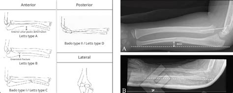 Schematic Illustrations Of Monteggia Fractures According To Their