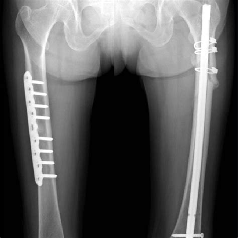 A Plate And Screws Fixation Of The Right Femoral Shaft And An