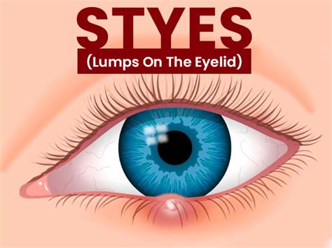 Stye Lump On The Eyelid Causes Symptoms Risk Factors Complication