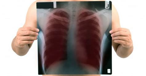A Tuberkulózis Tbc Diagnosztizálása Kezelése és Megelőzése Webbeteg