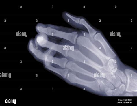 Hand X Ray High Resolution Stock Photography And Images Alamy